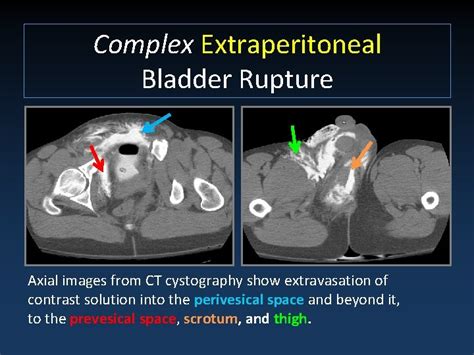 20k bladder tear test|bladder injury statistics.